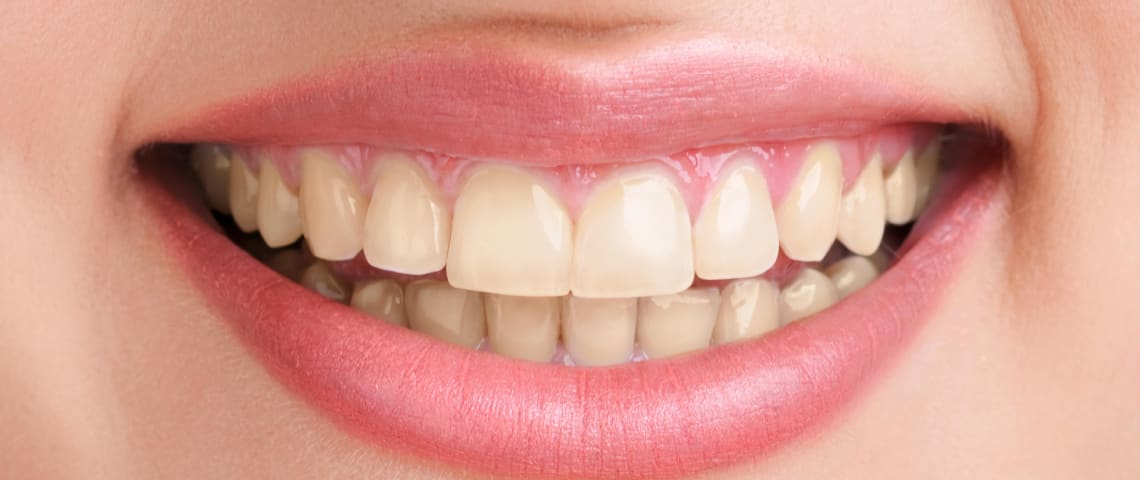 teeth whitening jhelum
